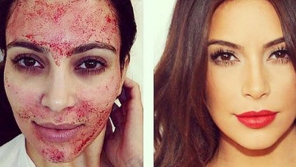 Kim Kardashian während und nach ihrem "Vampire-Facelift". (Foto: © pi42unapologeticbeautycare/instagram)